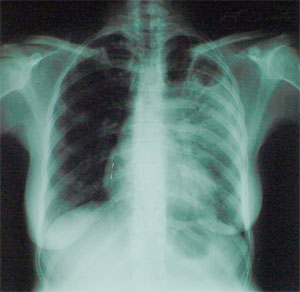 Рентгеновский снимок грудной клетки больного туберкулезом (фото с сайта www4.umdnj.edu)