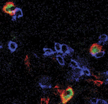 Регуляторные Т-клетки (красный и зеленый) взаимодействуют с Т-клетками, уничтожающими опухоль (синий), в ткани опухоли яичника (фото с сайта cmbi.bjmu.edu.cn)