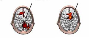 Слева: клетки бодрствующего мозга могут передавать полученные при транскраниальной стимуляции сигналы дальше, в участки мозга, отвечающие за восприятие, мышление и сознательные действия. Справа: сигнал, переданный клетками мозга, погруженного в глубокий сон, быстро гасится и не выходит далеко за пределы стимулируемого участка (изображение с сайта www.wisc.edu)