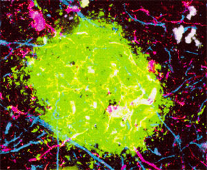 Флюоресцентное изображение амилоидной бляшки (фото с сайта users.drew.edu)