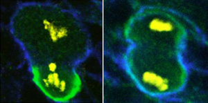 Слева: в норме нейробласт делится на большую клетку и маленькую, которая затем станет двумя нервными клетками. Справа: при молекулярном сбое асимметричное деление не происходит и развивается опухоль (изображение с сайта www.embl.org)