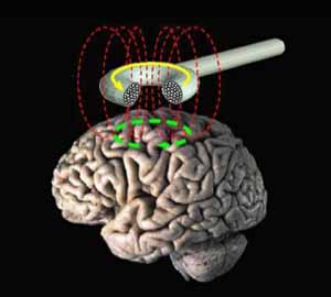 В отличие от транскраниального магнитного модулирования (на рисунке), ультразвуковой метод, предложенный Sony, позволяет фокусироваться на конкретных группах клеток мозга (рисунок с сайта intra.ninds.nih.gov)